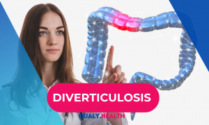 Diverticulosis